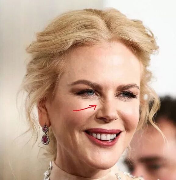 Madadin zuwa Botox