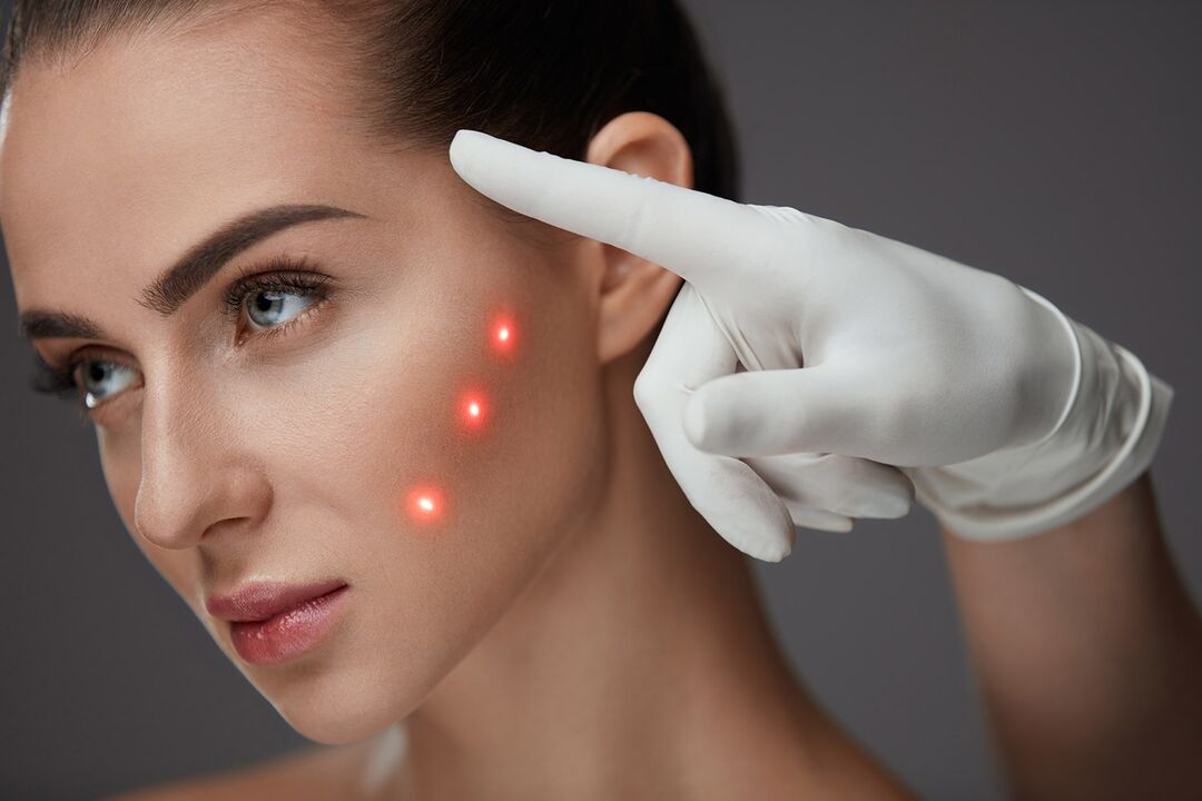 Laser fata rejuvenation